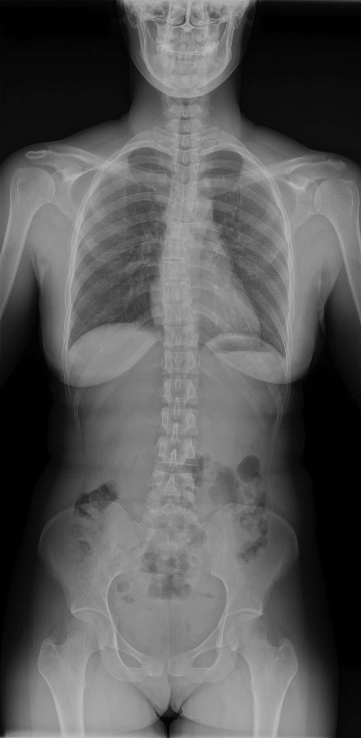 Radiografía panorámica de columna frontal para evaluar columna vertebral completa y escoliosis