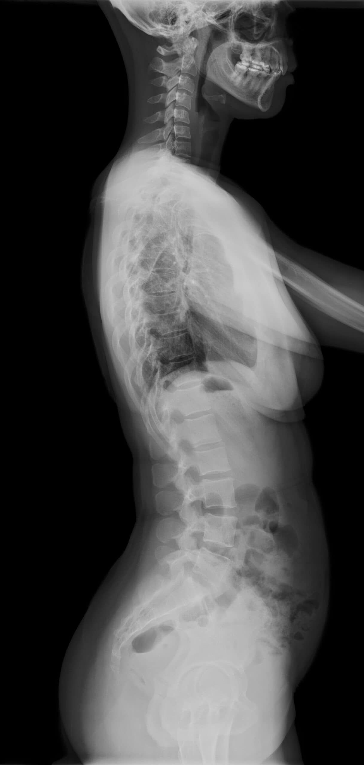 Radiografía panorámica de columna lateral para evaluar postura, cifosis, lordosis y balance sagital