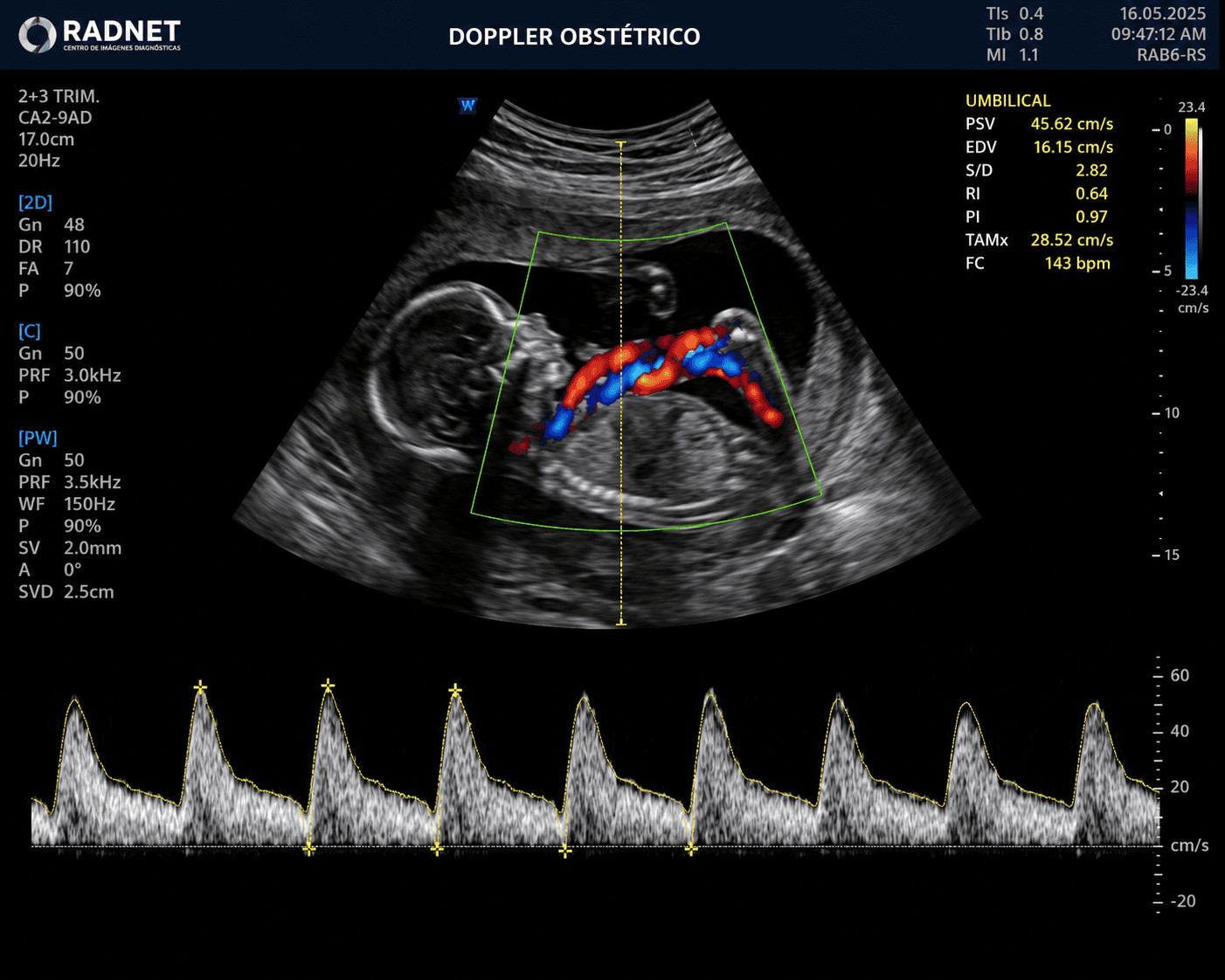 Doppler obstétrico fetal durante el embarazo para evaluar la circulación entre el bebé y la placenta